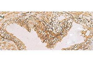 Immunohistochemistry of paraffin-embedded Human prost ate cancer tissue using RAB38 Polyclonal Antibody at dilution of 1:60(x200) (RAB38 抗体)