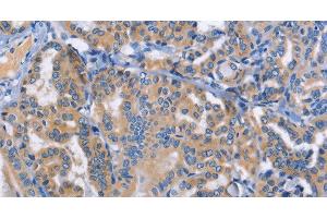 Immunohistochemistry of paraffin-embedded Human thyroid cancer tissue using DOK4 Polyclonal Antibody at dilution 1:50 (DOK4 抗体)