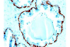 Formalin-fixed, paraffin-embedded human Prostate Carcinoma stained with Cytokeratin, HMW Monoclonal Antibody (SPM591). (Keratin Basic 抗体)