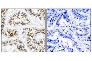 Immunohistochemical analysis of paraffin-embedded human breast carcinoma tissue using RelB(Phospho-Ser573) Antibody(left) or the same antibody preincubated with blocking peptide(right).