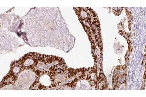 ABIN6267205 at 1/100 staining Human thyroid cancer tissue by IHC-P. (ULK1 抗体  (pSer467))