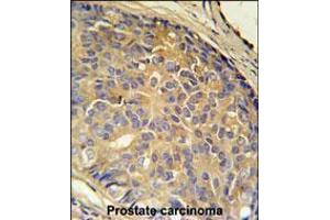 LOH12CR1 Antibody immunohistochemistry analysis in formalin fixed and paraffin embedded human prostate carcinoma followed by peroxidase conjugation of the secondary antibody and DAB staining. (LOH12CR1 抗体  (C-Term))