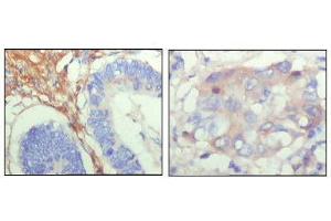 Immunohistochemical analysis of paraffin-embedded human colon cancer (left) and breast cancer (right) showing cytoplasmic localization with DAB staining using FBLN5 mouse mAb. (Fibulin 5 抗体  (AA 242-448))