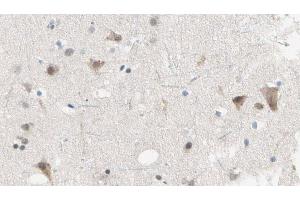 ABIN6274243 at 1/100 staining Human brain cancer tissue by IHC-P.