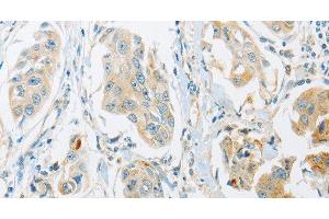 Immunohistochemistry of paraffin-embedded Human breast cancer tissue using ARHGEF10 Polyclonal Antibody at dilution 1:45 (ARHGEF10 抗体)