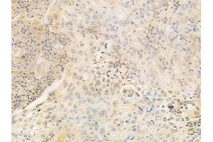 ABIN6259146 and ABIN6273735 at 1/100 staining human esophageal carcinoma by IHC-P. (PAX4 抗体  (Internal Region))