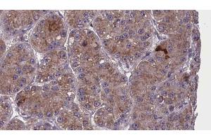 ABIN6273983 at 1/100 staining Human liver cancer tissue by IHC-P. (OR2T6 抗体  (C-Term))