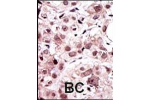 Formalin-fixed and paraffin-embedded human cancer tissue reacted with the primary antibody, which was peroxidase-conjugated to the secondary antibody, followed by AEC staining. (AXL 抗体  (N-Term))