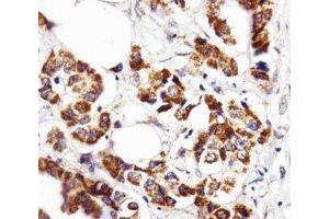 IHC analysis of FFPE human breast carcinoma section using INSRR antibody; Ab was diluted at 1:25. (INSRR 抗体  (AA 668-702))