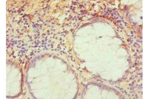 Immunohistochemistry of paraffin-embedded human colon cancer using ABIN7143276 at dilution of 1:100 (TRAF3IP2 抗体  (AA 1-300))