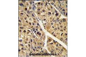 Formalin-fixed and paraffin-embedded human hepatocarcinoma reacted with PEX11A Antibody (N-term), which was peroxidase-conjugated to the secondary antibody, followed by DAB staining. (PEX11A 抗体  (N-Term))