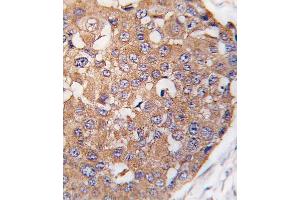 Formalin-fixed and paraffin-embedded human breast carcinoma tissue reacted with SNK Antibody (C-term ) (ABIN391375 and ABIN2841386) , which was peroxidase-conjugated to the secondary antibody, followed by DAB staining. (PLK2 抗体  (C-Term))