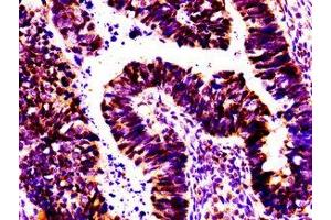 IHC image of ABIN7155808 diluted at 1:100 and staining in paraffin-embedded human ovarian cancer performed on a Leica BondTM system. (Msx2/Hox8 抗体  (AA 50-120))
