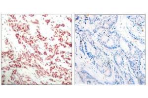 Immunohistochemical analysis of paraffin- embedded human breast carcinoma tissue using NF-κ,B p100 (phospho- ser866) antibody. (NFKB2 抗体  (pSer866))