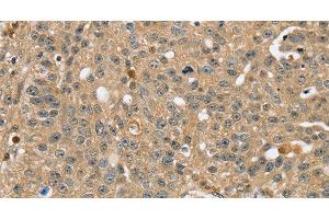 Immunohistochemistry of paraffin-embedded Human breast cancer using RNH1 Polyclonal Antibody at dilution of 1:40 (RNH1 抗体)