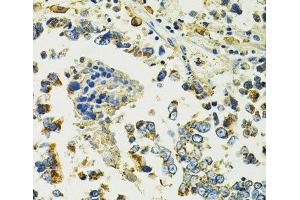 Immunohistochemistry of paraffin-embedded Human colon carcinoma using SLC25A11 Polyclonal Antibody at dilution of 1:100 (40x lens). (SLC25A11 抗体)