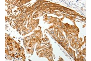 The image on the left is immunohistochemistry of paraffin-embedded Human cervical cancer tissue using ABIN7192814(TMSB10 Antibody) at dilution 1/15, on the right is treated with synthetic peptide.