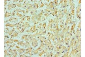 Immunohistochemistry of paraffin-embedded human liver cancer using ABIN7145312 at dilution of 1:100