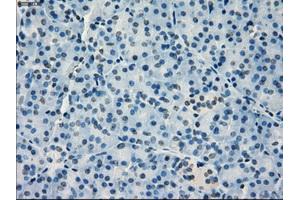 Immunohistochemical staining of paraffin-embedded Adenocarcinoma of breast tissue using anti-IRF3 mouse monoclonal antibody. (IRF3 抗体)