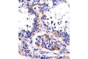 (ABIN390207 and ABIN2840690) staining DDIT4 in human lung adenocarcinoma tissue sections by Immunohistochemistry (IHC-P - paraformaldehyde-fixed, paraffin-embedded sections). (DDIT4 抗体  (N-Term))