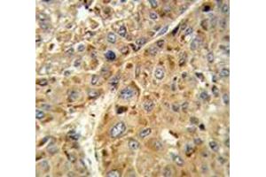 Immunohistochemistry analysis of human hepatocarcinoma tissue (Formalin-fixed, Paraffin-embedded) using Glutathione peroxidase 1 / GPX1  Antibody (C-term), followed by peroxidase-conjugated secondary antibody and DAB staining. (Glutathione Peroxidase 1 抗体  (C-Term))
