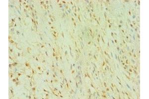 Immunohistochemistry of paraffin-embedded human breast cancer using ABIN7174010 at dilution of 1:100 (BLK 抗体  (AA 1-280))