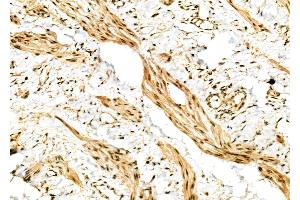 ABIN6264356 and ABIN6277009 at 1/100 staining Human ovarian cancer and adjacent normal tissues by IHC-P. (Periostin 抗体  (N-Term))