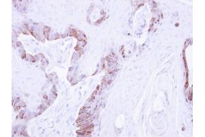 IHC-P Image Immunohistochemical analysis of paraffin-embedded CA922 xenograft , using LIM kinase 2, antibody at 1:500 dilution. (LIMK2 抗体)