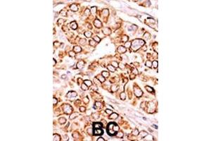 Formalin-fixed and paraffin-embedded human cancer tissue reacted with the primary antibody, which was peroxidase-conjugated to the secondary antibody, followed by AEC staining. (PIKFYVE 抗体  (AA 1531-1561))