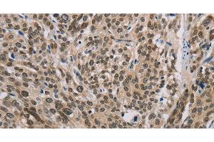 Immunohistochemistry of paraffin-embedded Human esophagus cancer using IRF9 Polyclonal Antibody at dilution of 1:50 (IRF9 抗体)