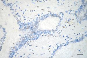 Immunohistochemistry was performed on paraffin-embedded human prostatic adenocarcinoma using PML antibody (ABIN7799924), 1:200).