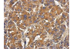 IHC-P Image Immunohistochemical analysis of paraffin-embedded human hepatoma, using Factor B, antibody at 1:500 dilution. (Complement Factor B 抗体)