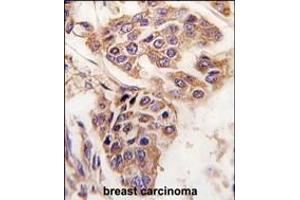Formalin-fixed and paraffin-embedded human breast carcinoma tissue reacted with C8orf32 antibody (Center), which was peroxidase-conjugated to the secondary antibody, followed by DAB staining. (WDYHV1 抗体  (AA 106-136))