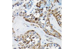 Immunohistochemistry of paraffin-embedded human thyroid cancer using PRC1 Rabbit pAb (ABIN6128502, ABIN6146124, ABIN6146125 and ABIN6222808) at dilution of 1:100 (40x lens). (PRC1 抗体  (AA 351-620))