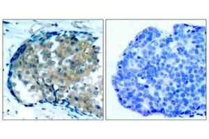 Immunohistochemical analysis of paraffin-embedded human breast carcinoma tissue using Ezrin(Phospho-Tyr353) Antibody(left) or the same antibody preincubated with blocking peptide(right). (Ezrin 抗体  (pTyr353))