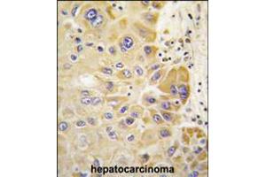 Formalin-fixed and paraffin-embedded human hepatocarcinoma tissue reacted with ALDH2 antibody , which was peroxidase-conjugated to the secondary antibody, followed by DAB staining. (ALDH2 抗体  (AA 318-347))