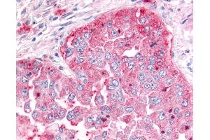 Anti-ADAMTS5 antibody IHC of human Lung, Non-Small Cell Carcinoma.