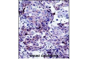 CTTN Antibody (Center) (ABIN657649 and ABIN2846644) immunohistochemistry analysis in formalin fixed and paraffin embedded human breast carcinoma followed by peroxidase conjugation of the secondary antibody and DAB staining. (Cortactin 抗体  (AA 273-302))