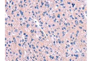 The image on the left is immunohistochemistry of paraffin-embedded Human liver cancer tissue using ABIN7190562(ENPP4 Antibody) at dilution 1/15, on the right is treated with synthetic peptide. (ENPP4 抗体)