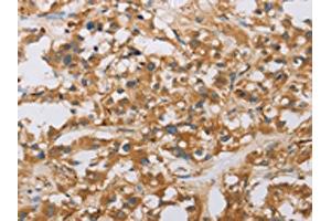 The image on the left is immunohistochemistry of paraffin-embedded Human thyroid cancer tissue using ABIN7130805(RAD54L2 Antibody) at dilution 1/40, on the right is treated with fusion protein. (ARIP4 抗体)
