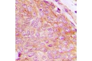 Immunohistochemical analysis of CHKB staining in human breast cancer formalin fixed paraffin embedded tissue section. (CHKB 抗体  (C-Term))