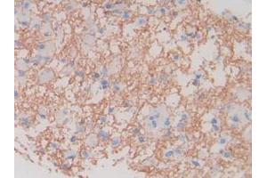 IHC-P analysis of Human Glioma Tissue, with DAB staining. (MBP 抗体  (AA 135-190))