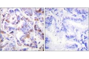 Immunohistochemistry analysis of paraffin-embedded human lung carcinoma, using RFA2 (Phospho-Thr21) Antibody. (RPA2 抗体  (pThr21))