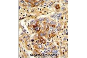 Formalin-fixed and paraffin-embedded human hepatocarcinoma with C Antibody (N-term), which was peroxidase-conjugated to the secondary antibody, followed by DAB staining. (CD163 抗体  (N-Term))