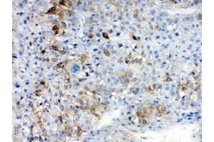 IHC testing of FFPE human liver cancer tissue with AKR1B10 antibody at 1ug/ml. (AKR1B10 抗体  (AA 285-316))