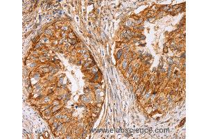 Immunohistochemistry of Human cervical cancer using CD59 Polyclonal Antibody at dilution of 1:50 (CD59 抗体)