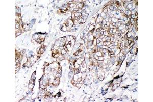 IHC-P: VE-Cadherin antibody testing of human lung cancer tissue (Cadherin 5 抗体  (AA 766-784))