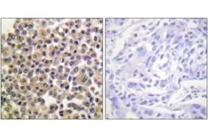 Immunohistochemistry analysis of paraffin-embedded human breast carcinoma, using p130 Cas (Phospho-Tyr249) Antibody. (BCAR1 抗体  (pTyr249))