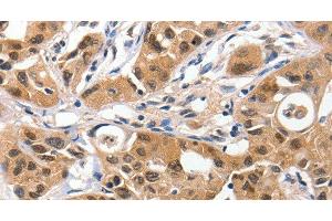 Immunohistochemistry of paraffin-embedded Human lung cancer using 14-3-3 epsilon Polyclonal Antibody at dilution of 1:100 (YWHAE 抗体)