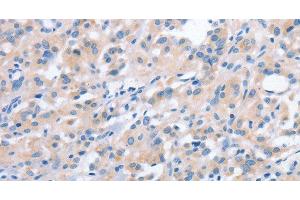 Immunohistochemistry of paraffin-embedded Human thyroid cancer using NCAPD2 Polyclonal Antibody at dilution of 1:40 (NCAPD2 抗体)